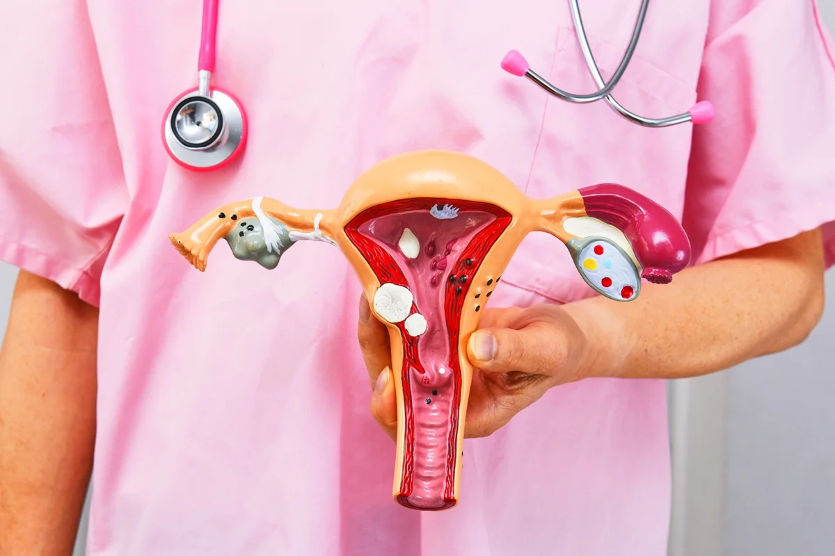 utero endometriose